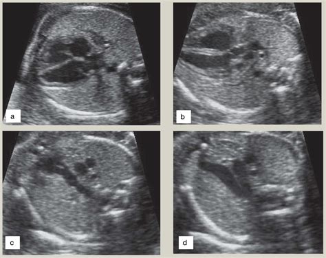 The Fetal Anomaly Scan Obstetrics Gynaecology And Reproductive Medicine