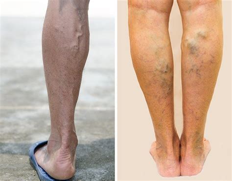 Varicose Veins Symptoms Premier Dermatology Atlanta