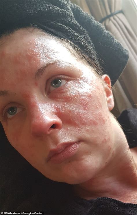 Mother Shares Shocking Pictures Of Her Severe Reaction To Hair Dye Lifestyle World News
