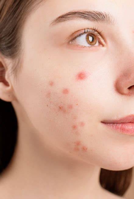 Understanding Acne Cosmetica Causes Best Remedies And The Importance