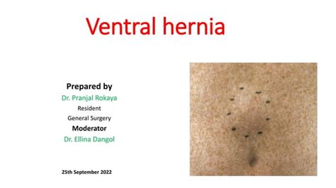Ventral Hernia Ppt