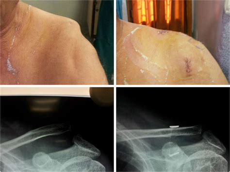 Pre-operative and post-operative, clinical and ...