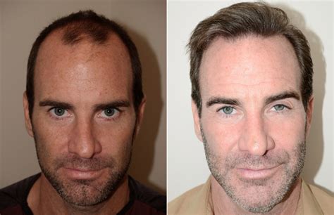 Male Hair Transplant Before And After Photos Foundation For Hair