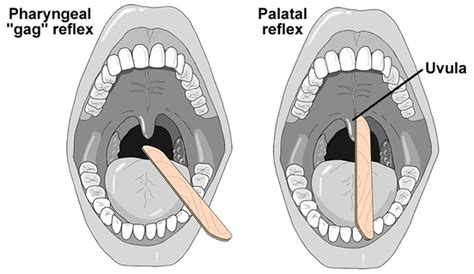 Cranial Nerves Ix And Cn X Testing Procedures Palatal Reflex And Gag