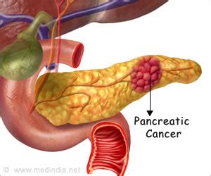 Pancreatic cancer is a cancer that's found anywhere in the pancreas. Early Detection Beneficial When Pancreatic Cancer Runs in ...