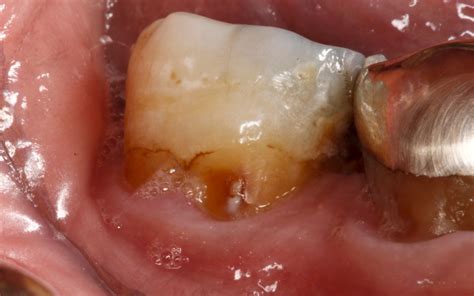 Tandförfall på rotytan MCCarl Dental Group Volta