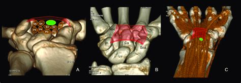 Normal Anatomy Of The Carpal Tunnel A B C Volume Rendered 3d