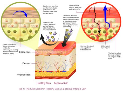 The Skin Barrier