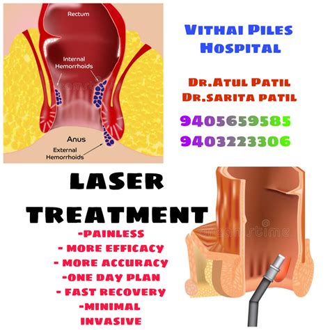 Vithai Piles Treatment Centre Is A Leading Clinic In The City Offering Treatment For Piles If