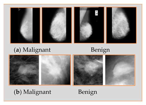 Applied Sciences Free Full Text Breast Cancer Detection Using