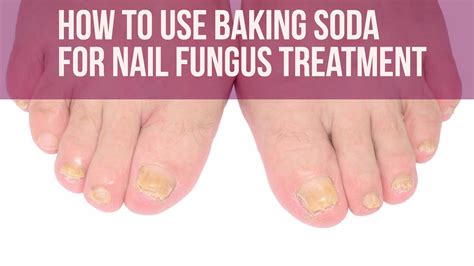 Baking Soda For Toenail Fungus 8 Diy Treatments For Toes And Feet
