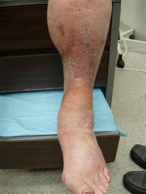 Painful Tightening Of The Skin On The Legs The Clinical Advisor