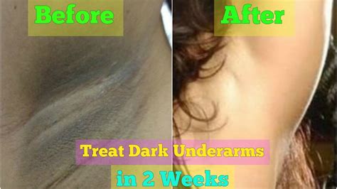lighten dark underarms permanently armpit whitening