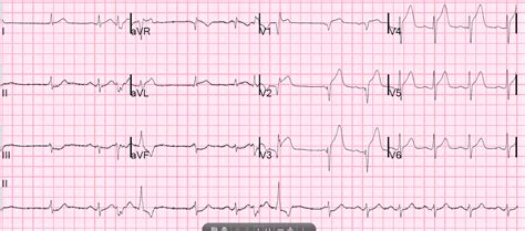 Dr Smiths Ecg Blog Anterior Stemi And Multiform Pvcs With Narrow