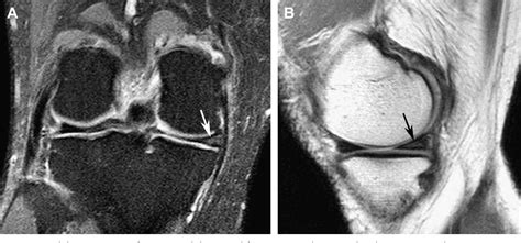 Figure From The Role Of The Meniscus In Knee Osteoarthritis A Cause My Xxx Hot Girl