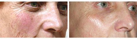 Clearlift Q Switched Pixel Laser Treatment Results Skin By Design