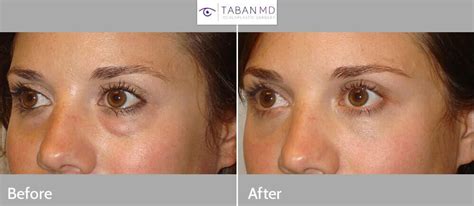 Under Eye Plastic Surgery Before And After Before And After