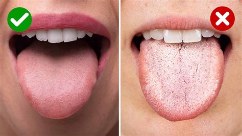 Normal Tongue Coating