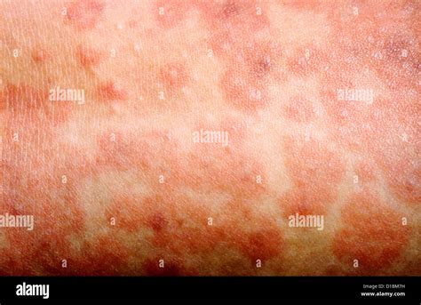 Measles Rash Stock Photo Alamy
