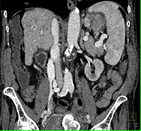 Pneumatosis Colon In Patient With Cirrhosis Colon Case Studies