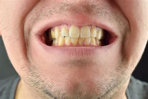 Help My Teeth Are Yellow Ja Duval Dds Orthodontist