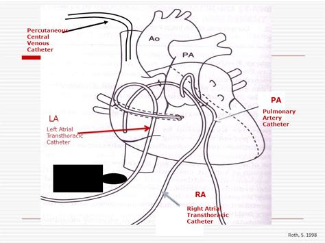 Transthoracic Intracardiac Catheters Tics Pediatric Ccrn Review Blog