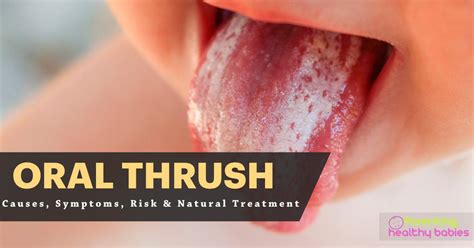 Oral Thrush Causes Symptoms Risk And Natural Treatment