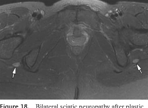 Figure 18 From Mr Imaging Of Entrapment Neuropathies Of The Lower