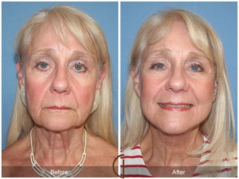 Before And After Facelift 50 Facelift Orange County