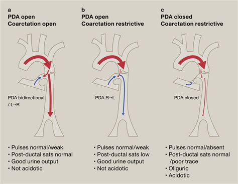 Presentation Of Coarctation Of The Aorta In The Neonates And The Infant