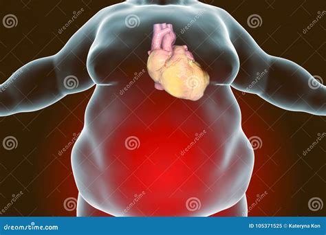 Heart Disease In Obesity Person Stock Illustration Illustration Of
