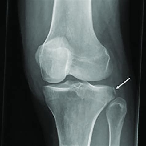 6 Anteroposterior Radiograph Depicting An Avulsion Fracture Of The