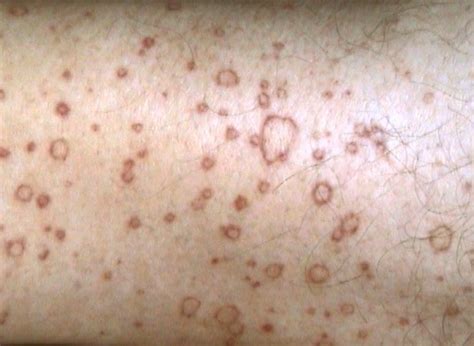 Porokeratosis Treatment Pictures Symptoms And Causes