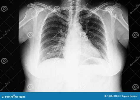 Enlarged Heart X Ray Images An Enlarged Heart Cardiomegaly Is An