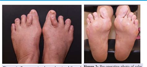 Pdf A Case Report Of Spontaneous Second Toe Varus Deformity