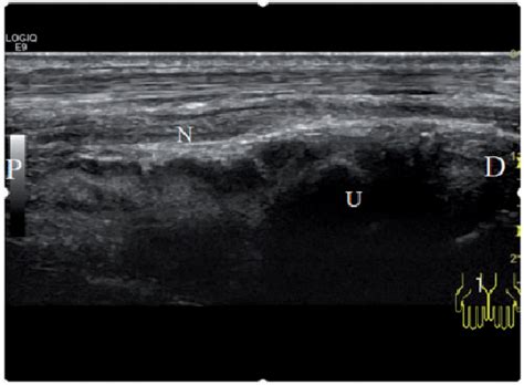 Figure 4 From An Intraneural Ganglion Cyst Of The Ulnar Nerve At The