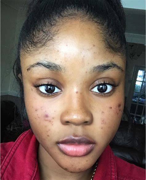 6 Bloggers Talk To Teen Vogue About Their Acne Journeys Teen Vogue