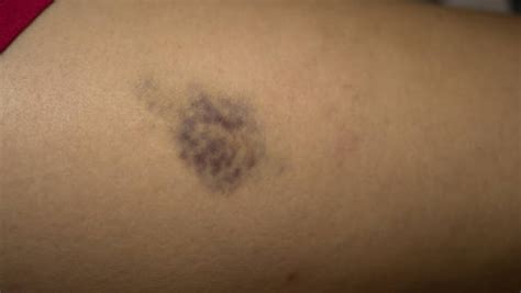 Hematoma Thigh Stock Photos Pictures And Royalty Free Images Istock