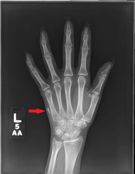 Glass Foreign Body Hand Radiograph Jetem