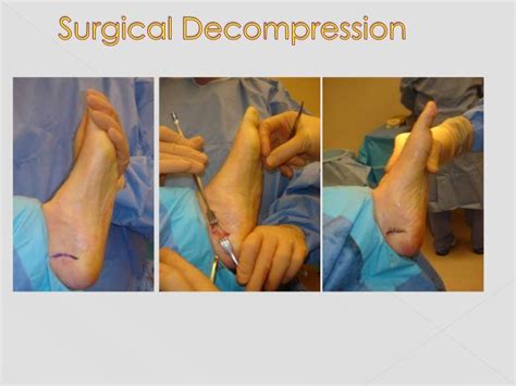 Nerve Compression Syndrome Foot Captions Hd
