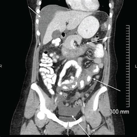Axial A And Coronal B Contrast Enhanced Ct Scan Of The Abdomen And