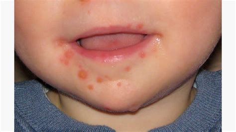 Hand Foot Mouth Disease On Legs
