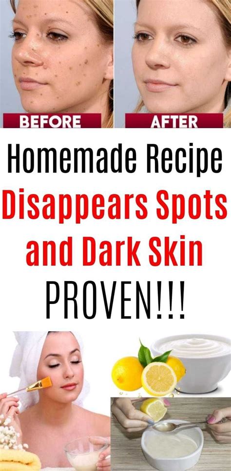 Homemade Recipe Disappears Spots And Dark Skin Proven Brown Spots