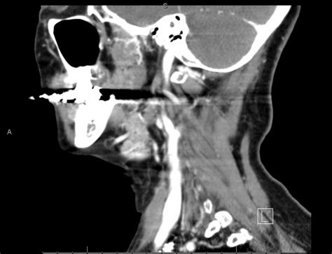 Chronic Submandibular Gland Sialadenitis Case Example Iowa Head And