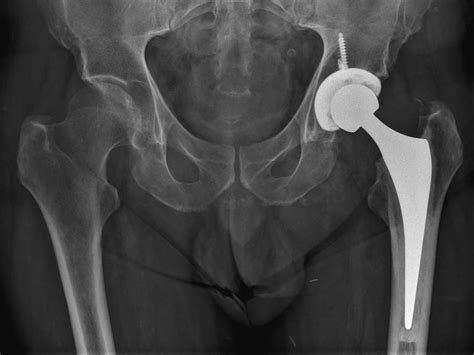 Total Hip Replacement X Ray