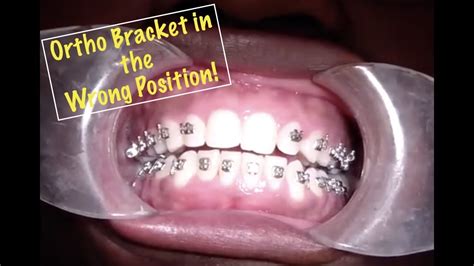 Ortho Bracket Repo Quick Review Youtube
