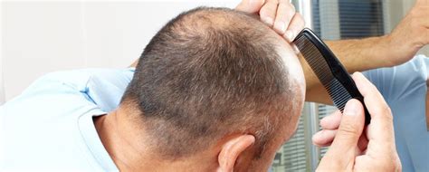 Males tend to lose hair from the temples and crown of the head. What is Hair Miniaturization and What Can I Do About It ...