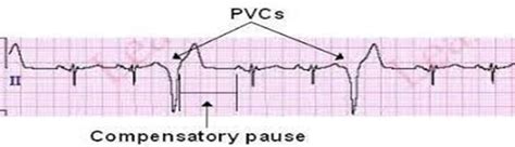 Unit 8 Premature Ventricular Contraction Pvcs Medtigo