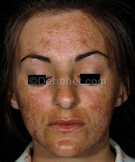 Melasma Photo Skin Disease Pictures