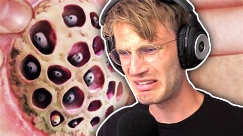 He lives in brighton, england. (WARNING GROSS) CURING MY TRYPOPHOBIA - YouTube